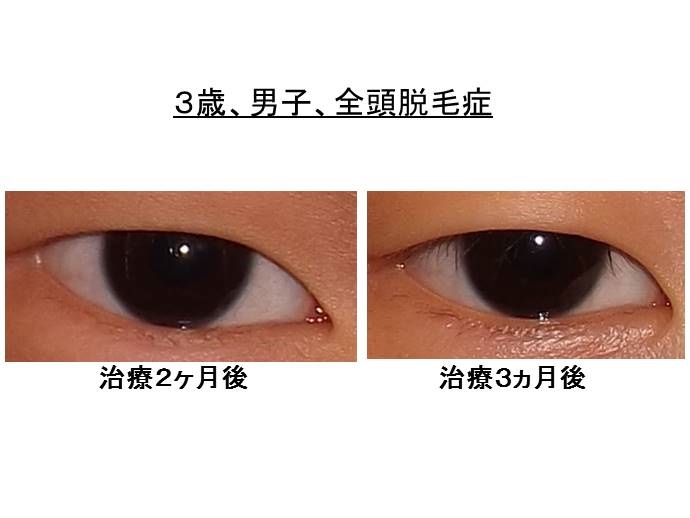 円形脱毛症　名医""